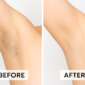permanent hair removal results borivali mumbai 85x85