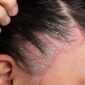 Sebopsoriasis Scalp Psoriasis Hairline 85x85