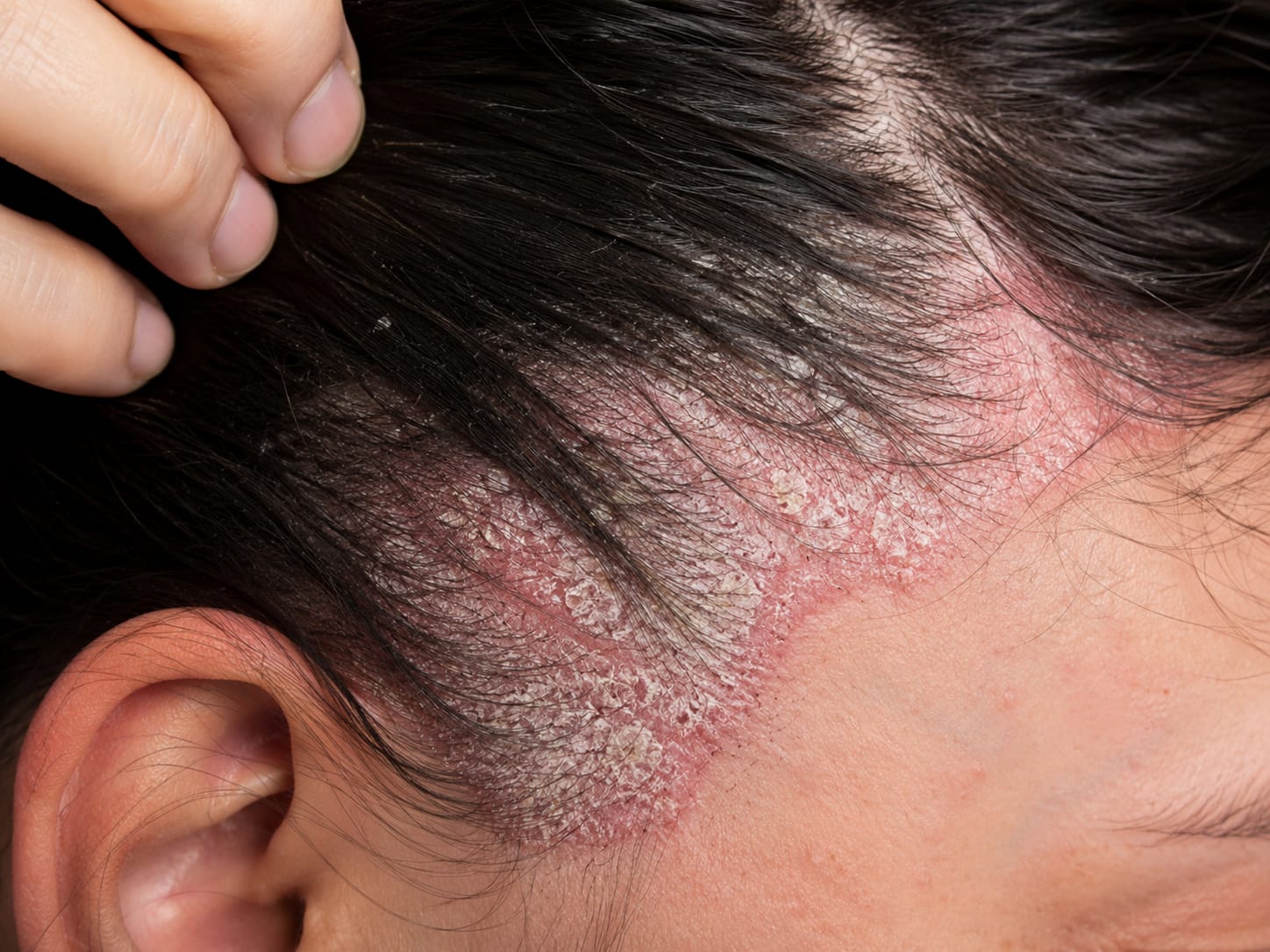 Sebopsoriasis or scalp psoriasis with red, inflamed plaques and thick white-yellow scaling along the scalp and hairline.