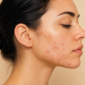 adult acne causes treatment borivali 85x85