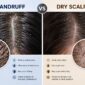 dandruff vs dry scalp difference 85x85
