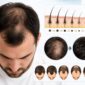 male pattern hair loss treatment borivali mumbai 85x85