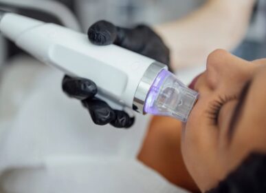 Microneedling treatment being performed on facial skin using a professional microneedling device
