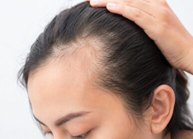 Receding hairline and frontal hair thinning in a woman, showing visible scalp and temple hair loss, suitable for hair loss treatment awareness.