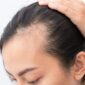receding hairline hair thinning treatment borivali mumbai 85x85
