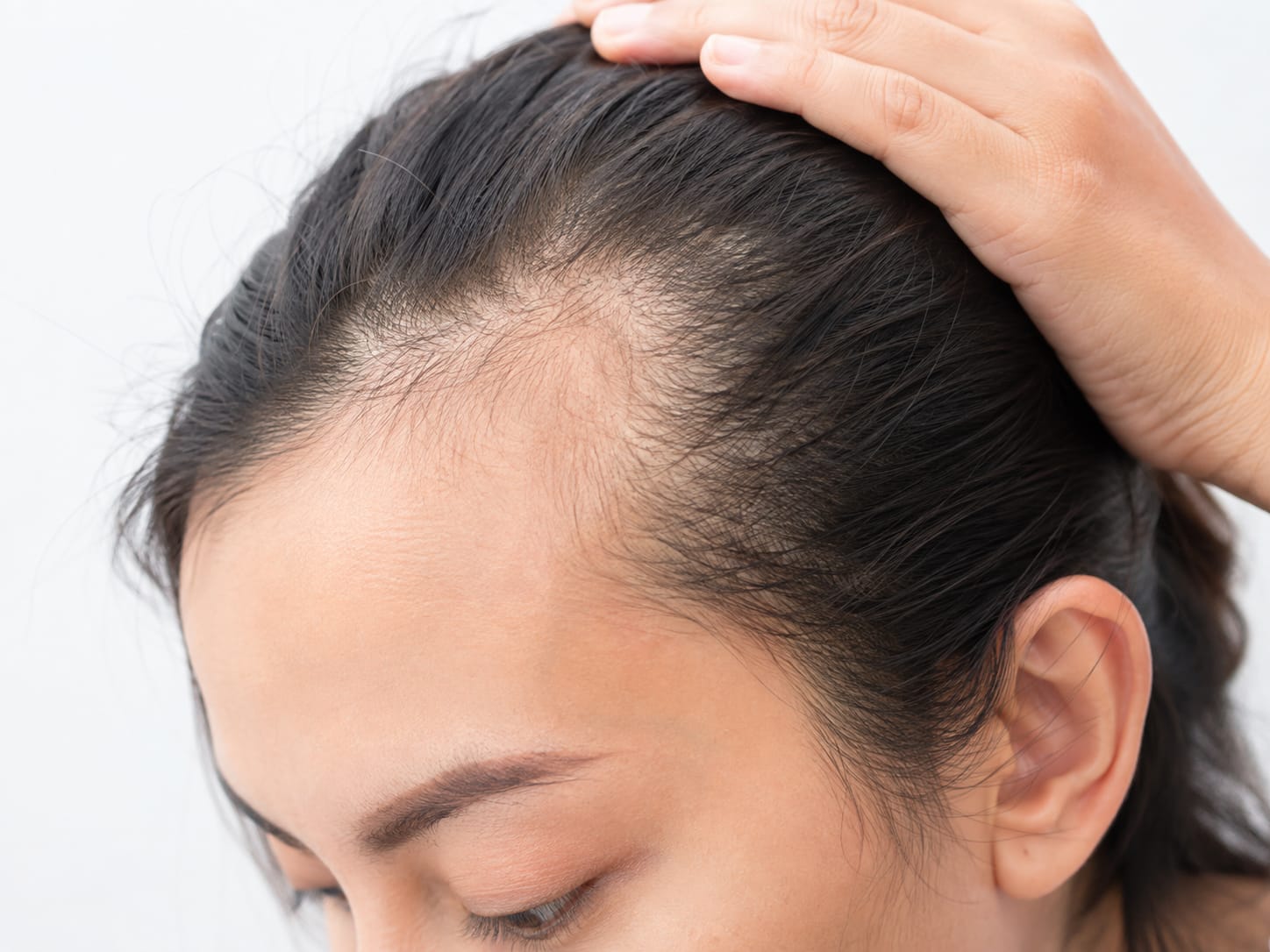Receding hairline and frontal hair thinning in a woman, showing visible scalp and temple hair loss, suitable for hair loss treatment awareness.