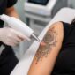 laser tattoo removal treatment borivali mumbai 85x85